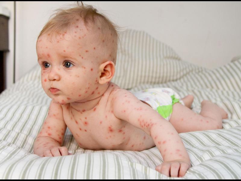 Combien de jours dure la varicelle ?